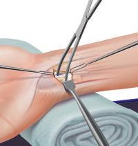 Centerline Endoscopic Carpal Tunnel Release Surgical Set Up The patient is positioned supine on the operating room table with the arm abducted on a hand table.