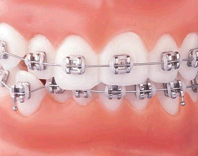 because of the long period of continued vertical growth, if the functional appliance is used for the first phase of treatment, posterior bite blocks or other