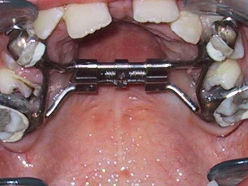 Case I Gap between the central incisors shows