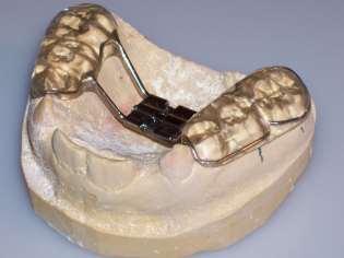 dentition: - Acrylic