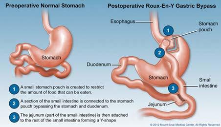 Gastric Bypass Small stomach pouch