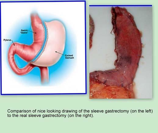 Sleeve Gastrectomy 75%-90% of stomach new stomach size/shape of a banana May decrease ghrelin levels/increase GLP-1 and GLP-2 BMI: