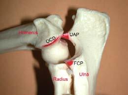 Elbow Dysplasia Elbow Dysplasia! Definition:! Ununited Anconeal Process (UAP)! Medial Compartment Disease (MCD)! Fragmented Medial Coronoid Process (FMCP)! Osteochondritis Dissicans!