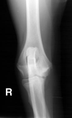 OCD! PE:! Pain on joint extension or flexion (depends on which joint it is)! Muscle atrophy (disuse)!