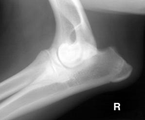 Crepitus, joint effusion, periarticular swelling OCD!Diagnosis!