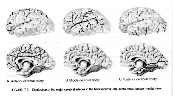 (CVA) A focal neurological