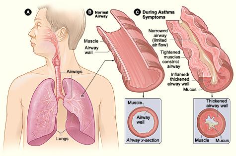 Apr 16 4:06 PM Respiratory Disorders 2. Asthma The main reason children are sent to a hospital in Canada.