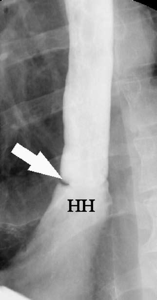 hernia (HH) (brought out by the increased intra-abdominal pressure with the patient in the semiprone position). C.