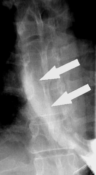 Allen and Colleagues D E FIGURE 2. (continued) D. Spontaneous reflux of gastric barium (arrows) with the patient in the supine position. The barium refluxed to the level of the thoracic inlet. E. Obstruction of the ingested 13- mm tablet (T) at the level of the distal mucosal ring.