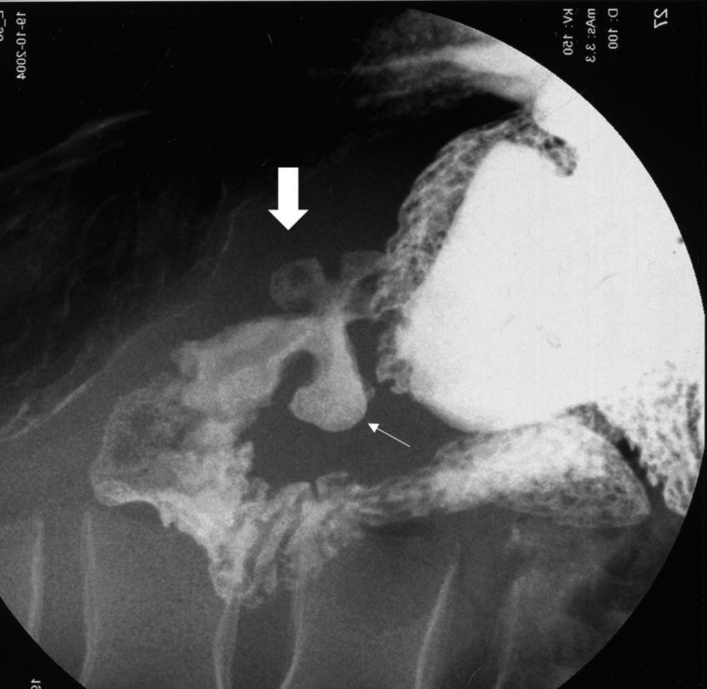 Fig. 17: Bulbar ulcer (arrow) with deformity of