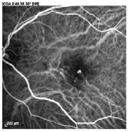 scotomas in both eyes MACULAR TELANGIECTASIA (MACTEL2) MACTEL2 ILM