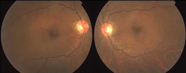 Adult Vitelliform Dystrophy CASE #4 SOLAR MACULOPATHY Brief case history 64 yo male presents w/ c/o blurred vision
