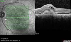 metamorphopsia and decreased vision x few months BCVA 20/20-1 OD, 20/30-2 OS AMD TREATMENT AND MANAGEMENT OF
