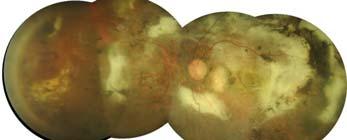 Choroidal melanomas CASE #6 Brief case history: 85 yo legally blind AA male referred by outside clinic for eval of