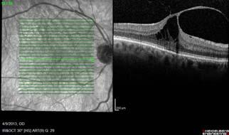 Macular hole Brief case history: 74 yo male c/o metamorphopsia OD for few months Acuities: