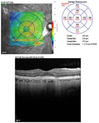 Clinical Endpoints for the Study of Geographic Atrophy Secondary to Age-Related Macular Degeneration; Retina (2016) 336, 1806-1822.