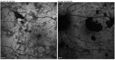 Half-dose Photodynamic Therapy for Chronic Central Serous Chorioretinopathy: Efficacy and Safety Outcomes in Real World; Photodiagnosis and Photodynamic Therapy (2016) 14, 173-177.