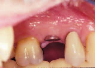 recognize the reduction or lack of peri-implant keratinized mucosa at the time of implant surgery.