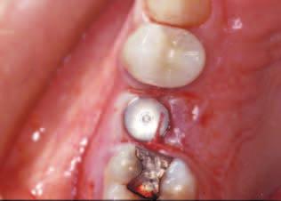 implant penetration into a contaminated environment of the oral cavity was a prerequisite for the long-term success of dental implants (Schroeder et