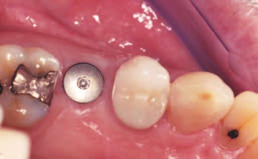 As with soft-tissue grafting around natural teeth, these surgical procedures can be categorized as either vascularized or non-vascularized (free) grafts.