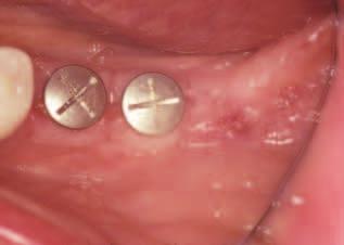 (buccal view) of non-submerged implants 37 and 36.