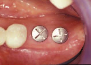 release undermining the buccal flap.
