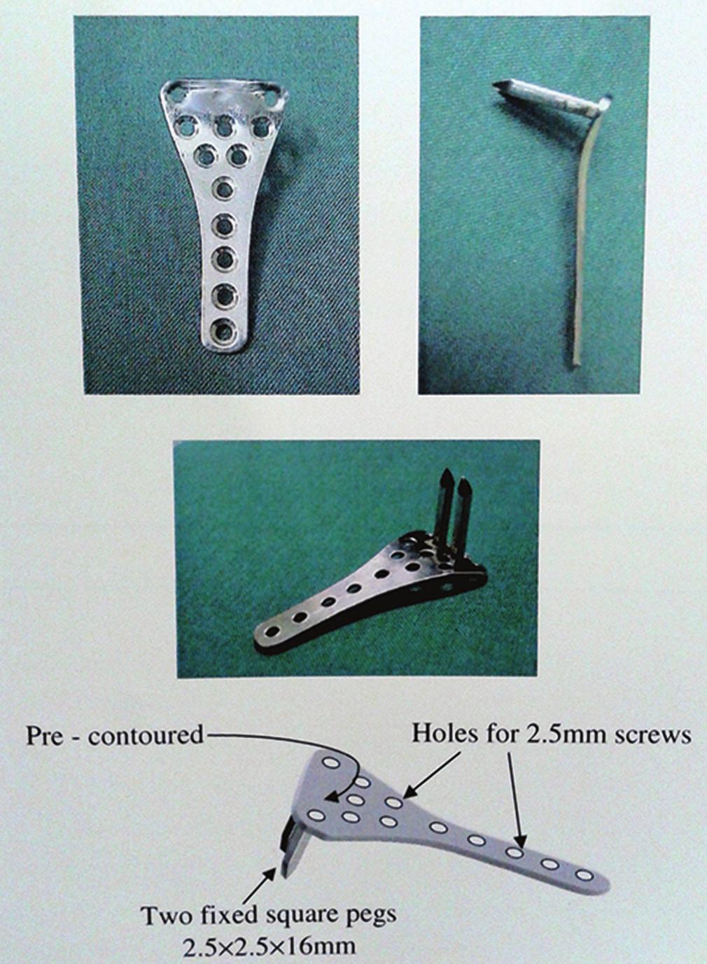 support to the comminuted distal radius, corresponding to its anatomical shape. The plate allows two 2.
