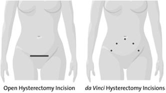 reconstruction When compared to the open approach, da Vinci offers the patient and surgeon numerous potential benefits 1 cm Slide 7 Patient Expectations and Benefits Less post-operative pain Less