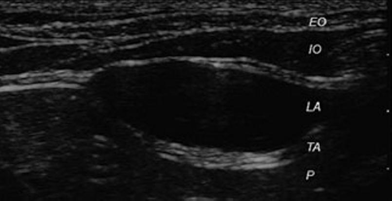 Figure 2 Ultrasonographic image obtained in a live patient post-injection of local anesthetic solution (5 ml of 0.125% bupivacaine) into the fascial plane overlying the transversus abdominis.