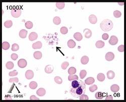 EDUCATIONAL COMMENTARY BLOOD CELL IDENTIFICATION Educational commentary is provided through our affiliation with the American Society for Clinical Pathology (ASCP).