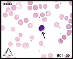 A normal lymphocyte is shown in BCI-09. Lymphocytes vary in size. The one pictured here is a small lymphocyte.
