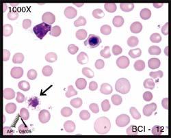 The arrow in BCI-12 identifies a giant platelet. The term giant is used to describe a platelet that is larger than a normal red blood cell.