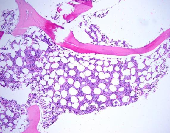 myeloproliferative neoplasm primarily