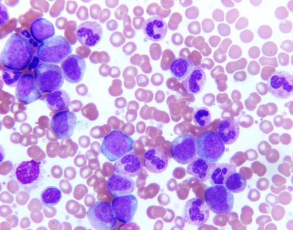 4 k/cumm Blasts: 1% Promyelocytes: 6% Myelocytes: 22% Metamyelocytes: 11% Bands: 13% Neutrophils: 37% Lymphocytes: 1% Monocytes: 3% Eosinophils: 4% Basophils: 5% Case 2 Hemoglobin: 10.