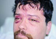 Traumatic asphyxia Deep purple skin color of head and neck Bilateral subconjunctival hemorrhage Petechiae Facial edema 40 Traumatic asphyxia Caused by severe compression of chest by extremely heavy