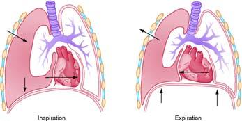 Open pneumothorax Assessment findings Defect in chest wall To-and-fro air motion out of defect Penetrating injury to chest, does not seal itself Sucking sound on inhalation (sucking chest wound)