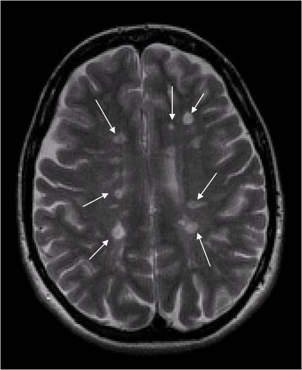 Example: lesion counts in multiple sclerosis Progressive, degenerative disease of the central nervous system Inflammation and tissue damage in the brain Lesions