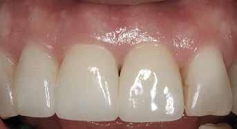 buccal plate is involved. The addition of autogenous connective tissue grafts with immediate implants has been discussed by several authors.