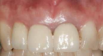 17 One possible downside to the use of autogenous SCTGs concerns whether elevating the periosteum from the thin buccal plate might compromise the blood supply and cause further crestal bone loss.