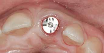 Incisal view of the left central incisor after implant placement but prior to placement of the provisional on the same day.