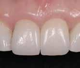 There was 3 mm of gingival asymmetry, and the patient had a thick biotype.