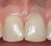 Two years after surgery, there was a 2-mm discrepancy in gingival levels and a dark gingival appearance.