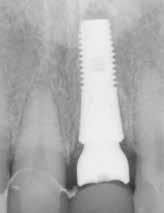 The implant placement procedure was completed without the use of an SCtg (Figure 5).