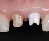The patient became increasingly aware of the slow gradual change and the dark gingival appearance above the left central