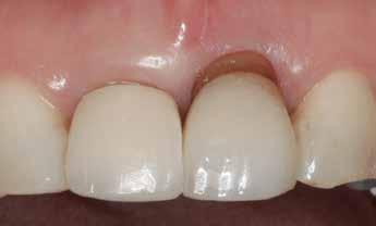 Full-Thickness SCTGs Case 3 The patient in Case 3 (Figure 8 through Figure 15) exhibited gingival asymmetry of her central