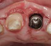 The treatment plan called for extraction of the left central incisor and replacement with an immediate implant along with