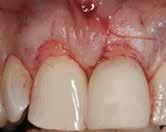 This technique, which entails minimal recipient preparation of the site, is flapless and the buccal gingiva is not elevated off the buccal plate or crest.