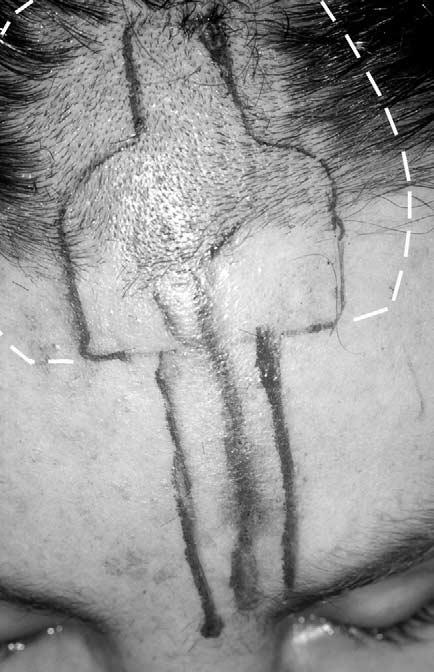 POTTER, DUCIC, AND ELLIS 567 FIGURE 2. Photograph showing the forehead flap after its dissection from the pericranium (white arrows) and elevation to the level of the brow. FIGURE 1.
