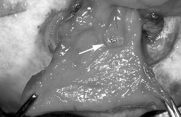 568 EXTENDED BILAMINAR FOREHEAD FLAP FIGURE 4. Photograph showing pericranial flap pierced by the bone grafts. Arrow indicates the microscrew used to secure 2 grafts together.