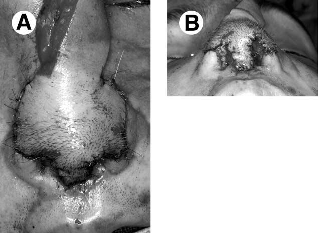 Photograph showing pericranial flap lining the internal nasal defects (white arrows) before providing any additional skeletal support to the tip (ie, cartilage) and before insetting the skin portion